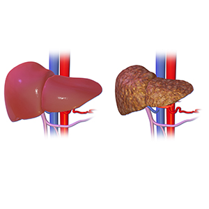 Cirrhosis Liver Model